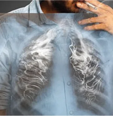 Smoking and Lung Cancer